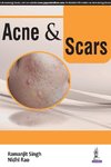Singh, R: Acne & Scars