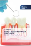 SOCKET SHIELD TECHNIQUE IN IMPLANTS