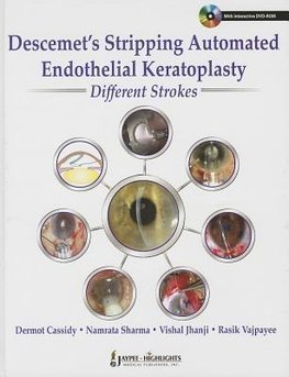 Descemet's Stripping Automated Endothelial Keratoplasty