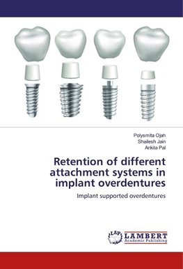 Retention of different attachment systems in implant overdentures