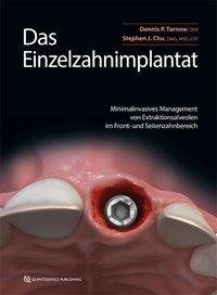 Das Einzelzahnimplantat