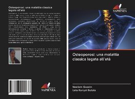 Osteoporosi: una malattia classica legata all'età