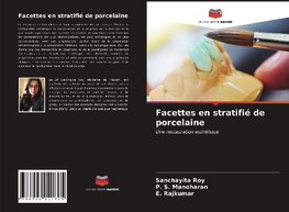 Facettes en stratifié de porcelaine