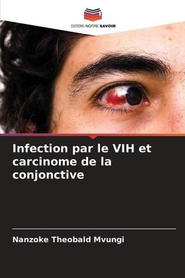 Infection par le VIH et carcinome de la conjonctive