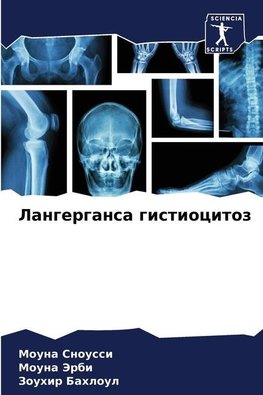 Langergansa gistiocitoz