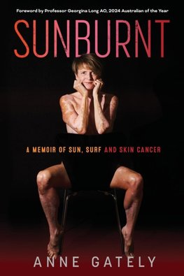 SUNBURNT