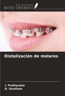 Distalización de molares