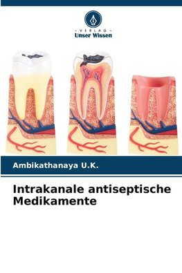 Intrakanale antiseptische Medikamente