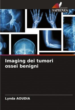 Imaging dei tumori ossei benigni