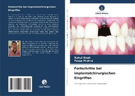 Fortschritte bei implantatchirurgischen Eingriffen