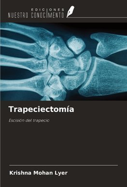 Trapeciectomía