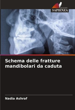 Schema delle fratture mandibolari da caduta