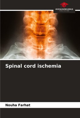 Spinal cord ischemia