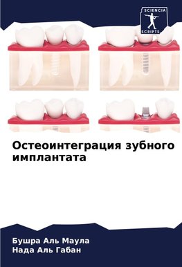 Osteointegraciq zubnogo implantata