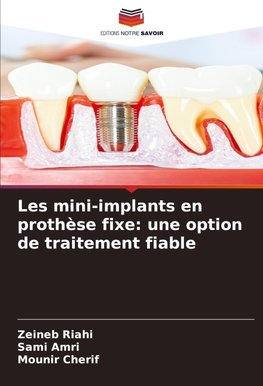 Les mini-implants en prothèse fixe: une option de traitement fiable