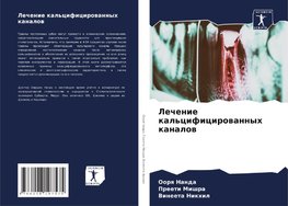 Lechenie kal'cificirowannyh kanalow