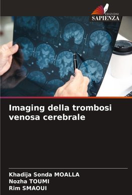 Imaging della trombosi venosa cerebrale