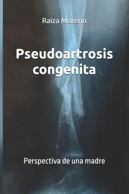 Pseudoartrosis congenita