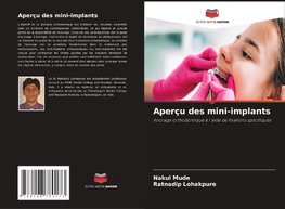 Aperçu des mini-implants