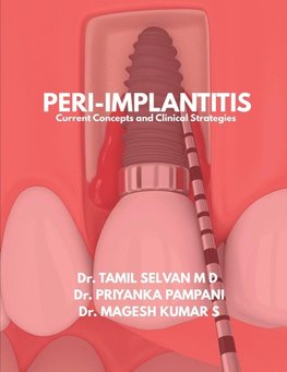 Peri-Implantitis